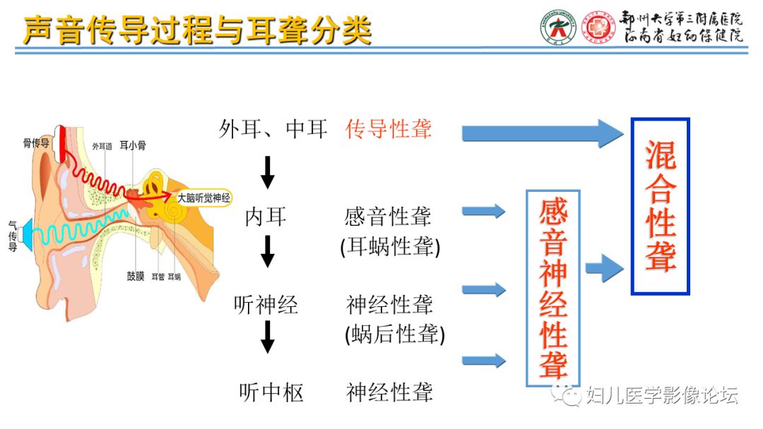 影像PPT - 【PPT】感音神经性耳聋影像诊断-4