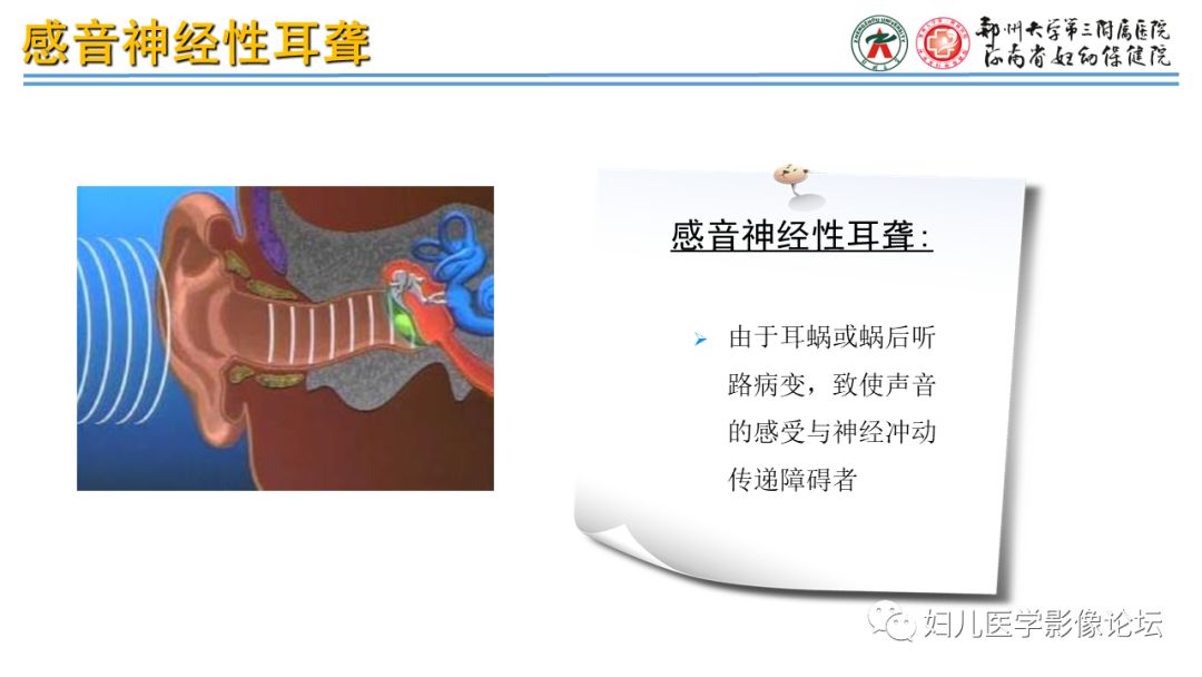 影像PPT - 【PPT】感音神经性耳聋影像诊断-5