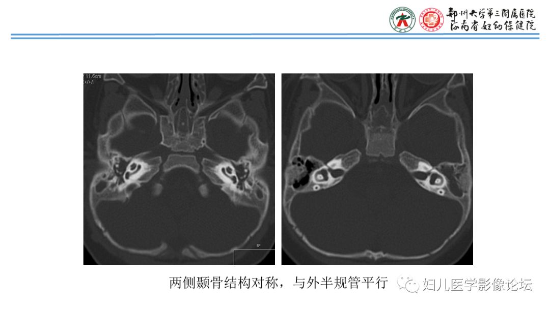 影像PPT - 【PPT】感音神经性耳聋影像诊断-8