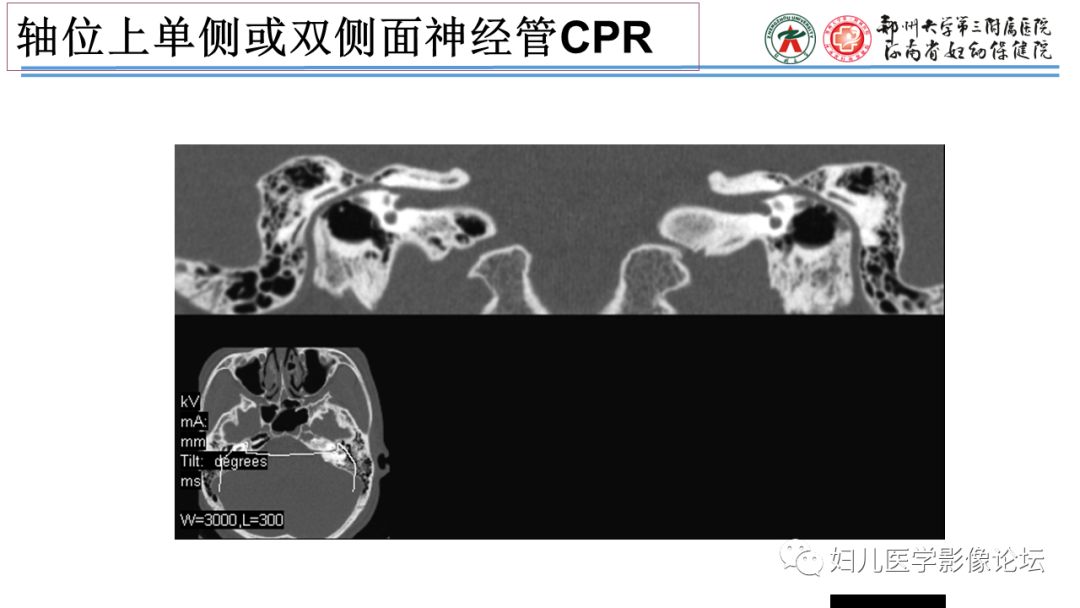 影像PPT - 【PPT】感音神经性耳聋影像诊断-18