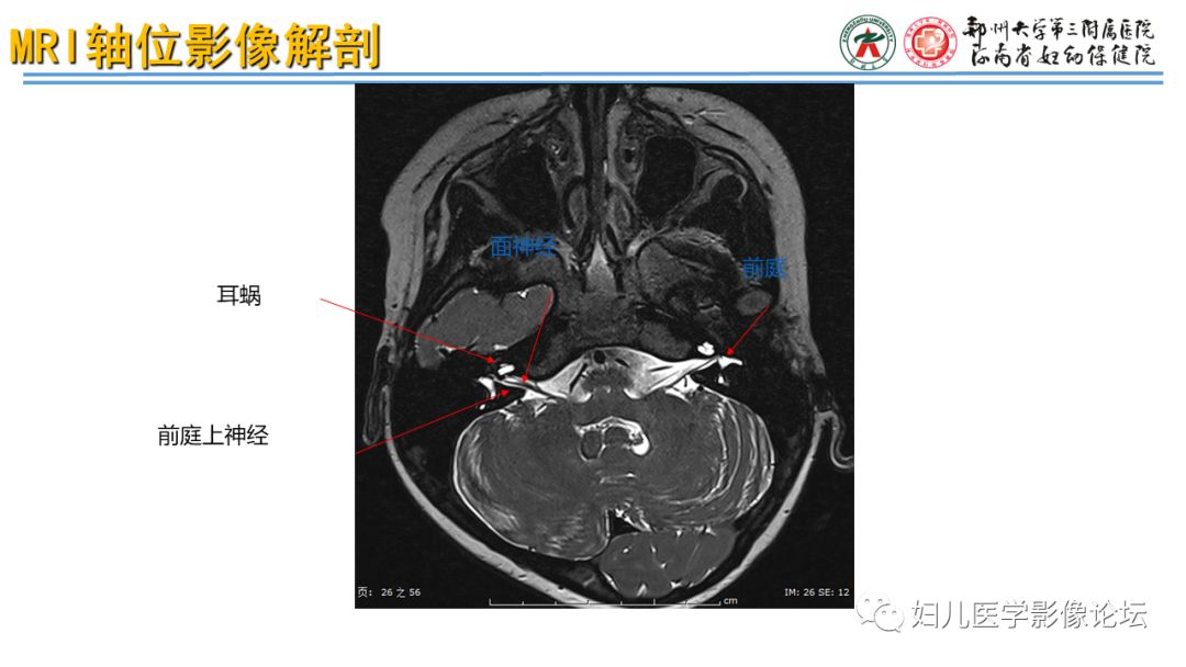 影像PPT - 【PPT】感音神经性耳聋影像诊断-22