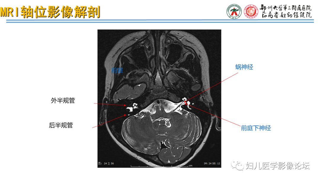 影像PPT - 【PPT】感音神经性耳聋影像诊断-23