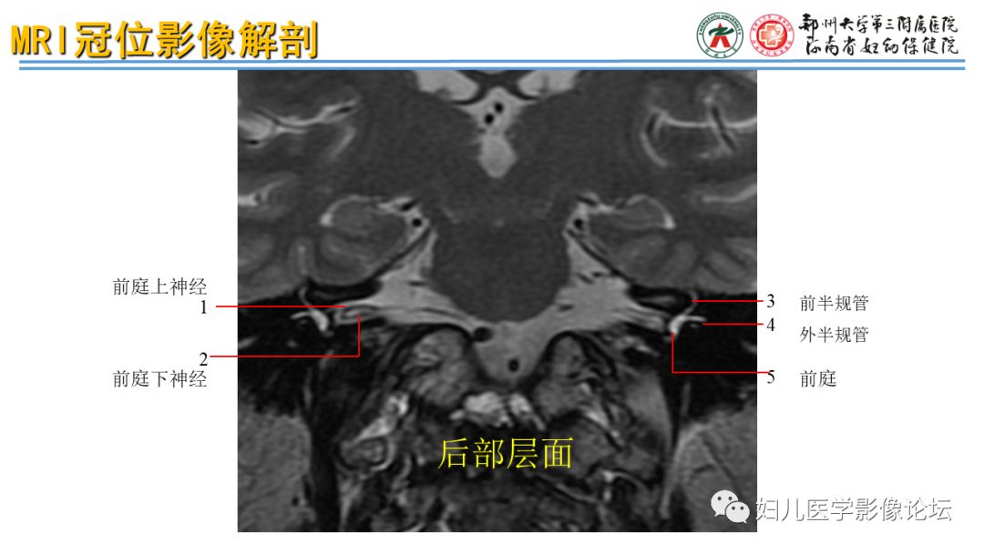 影像PPT - 【PPT】感音神经性耳聋影像诊断-25