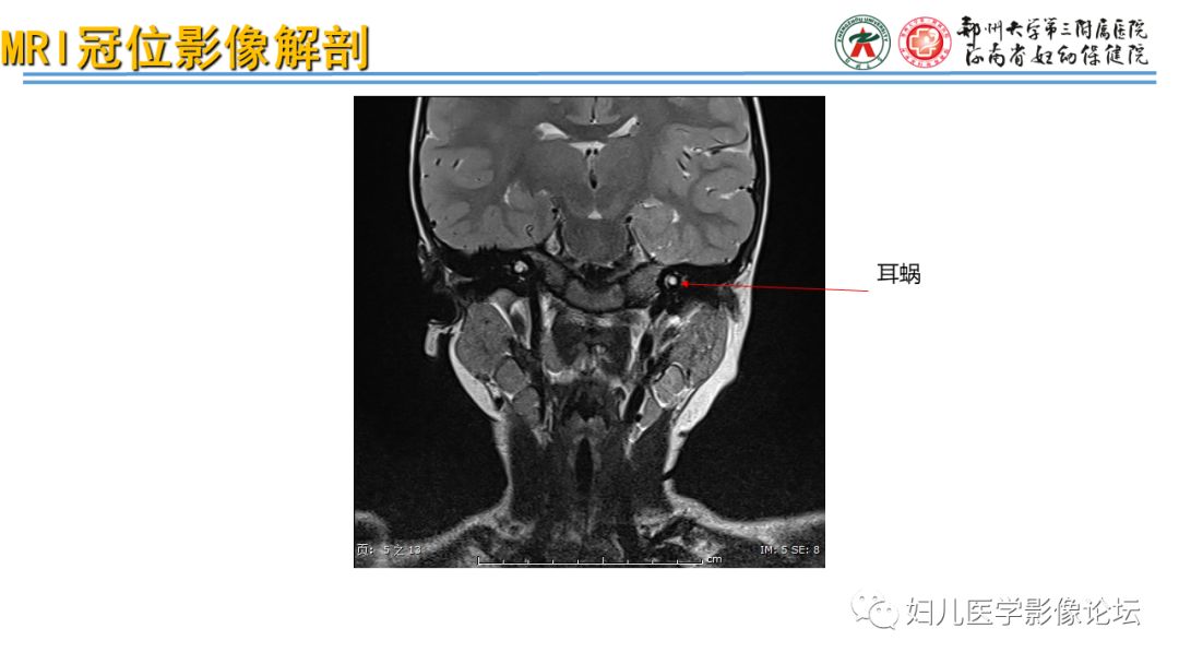 影像PPT - 【PPT】感音神经性耳聋影像诊断-26