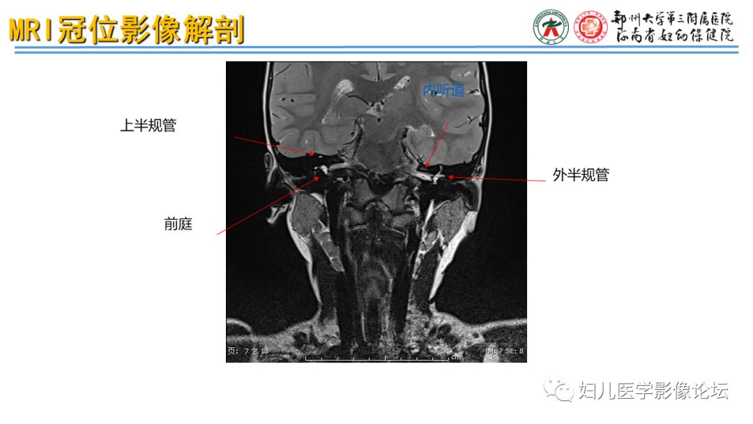 影像PPT - 【PPT】感音神经性耳聋影像诊断-27