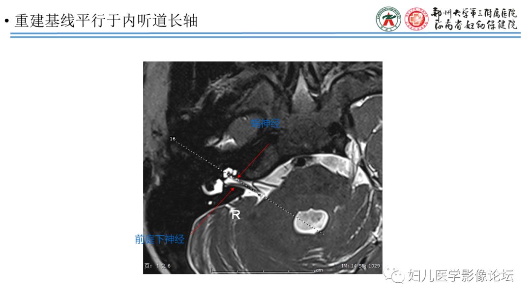 影像PPT - 【PPT】感音神经性耳聋影像诊断-28
