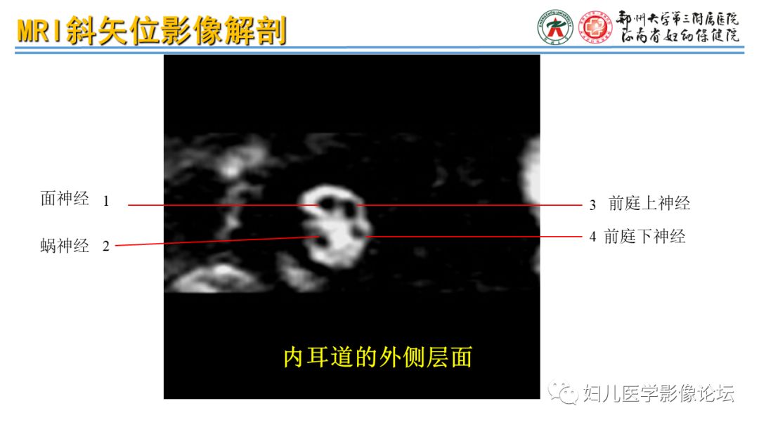 影像PPT - 【PPT】感音神经性耳聋影像诊断-29