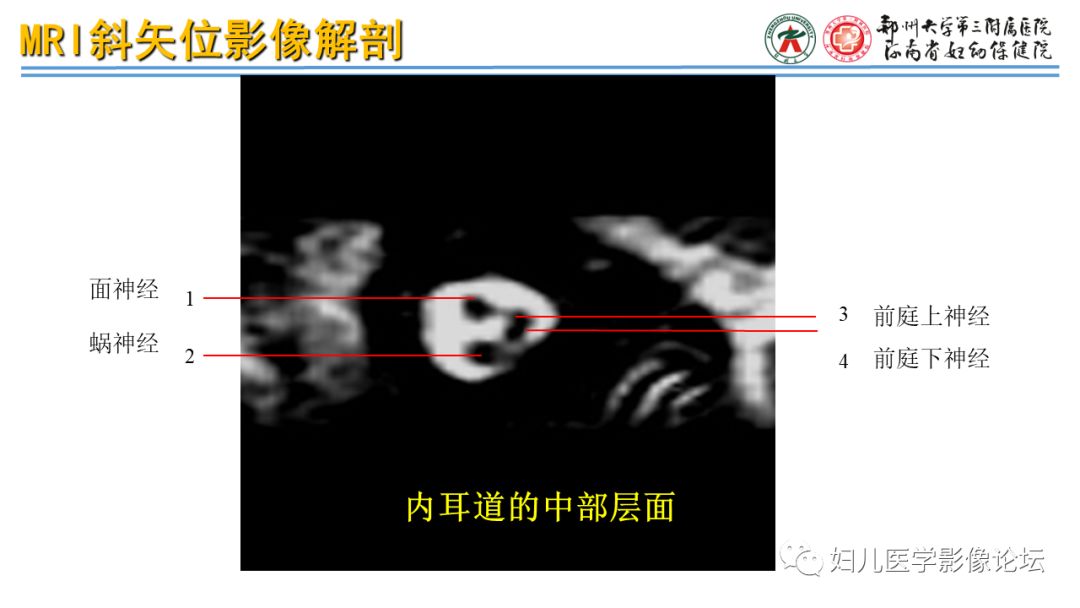 影像PPT - 【PPT】感音神经性耳聋影像诊断-30