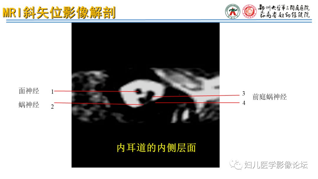 影像PPT - 【PPT】感音神经性耳聋影像诊断-31