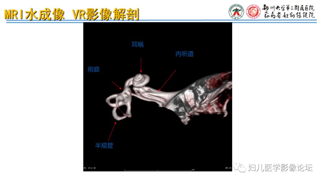 影像PPT - 【PPT】感音神经性耳聋影像诊断-32