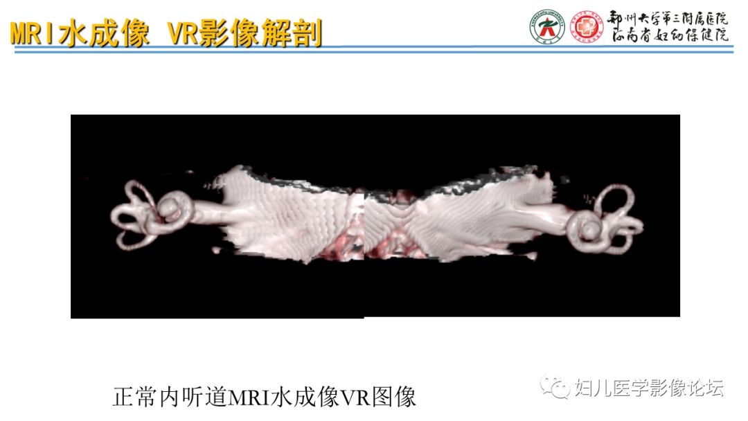 影像PPT - 【PPT】感音神经性耳聋影像诊断-33