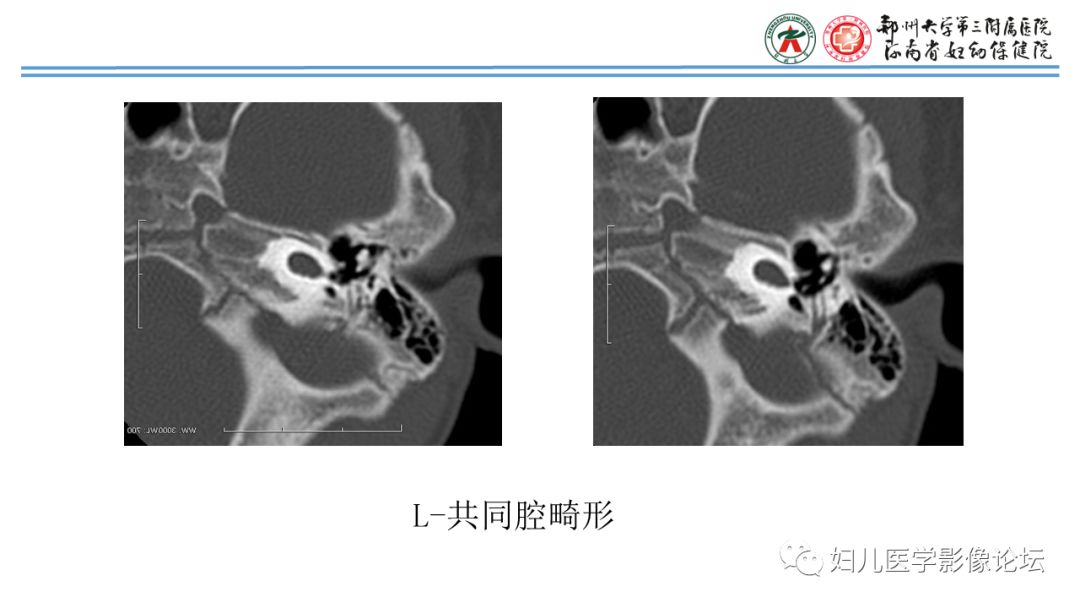 影像PPT - 【PPT】感音神经性耳聋影像诊断-41