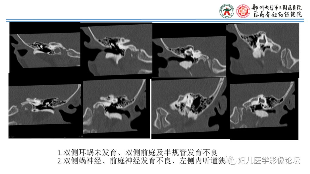 影像PPT - 【PPT】感音神经性耳聋影像诊断-44