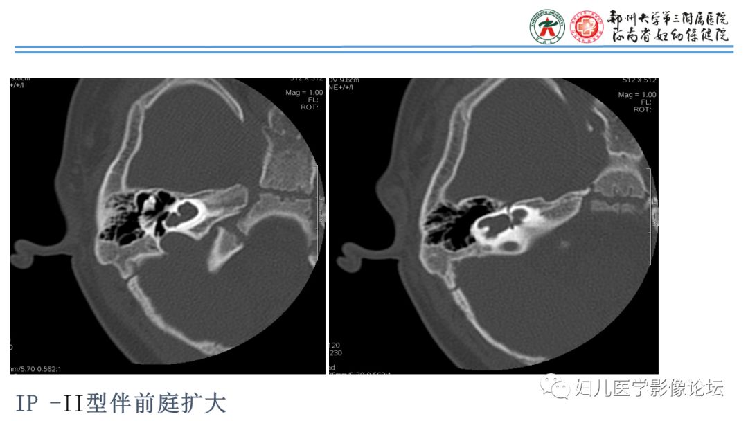 影像PPT - 【PPT】感音神经性耳聋影像诊断-54