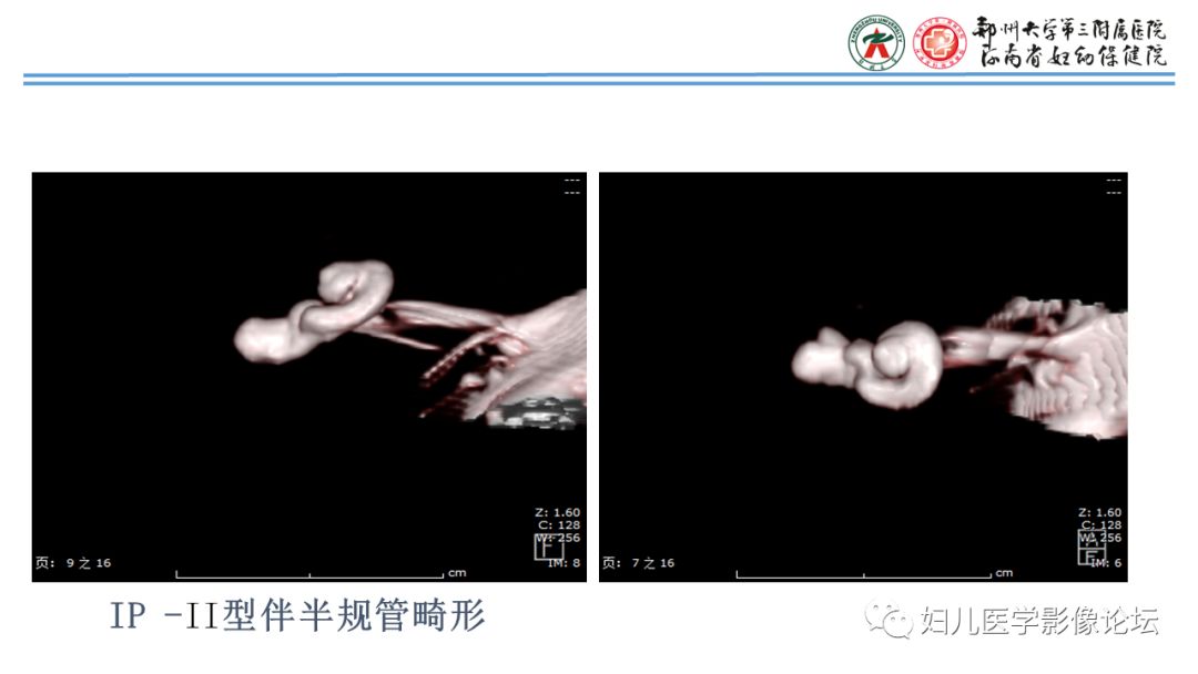 影像PPT - 【PPT】感音神经性耳聋影像诊断-55