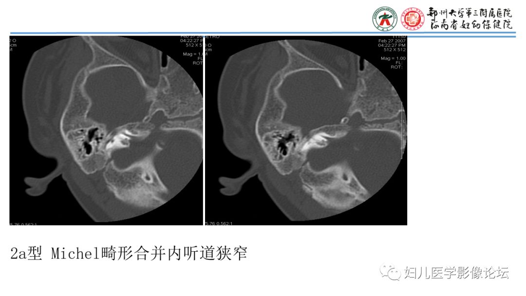 影像PPT - 【PPT】感音神经性耳聋影像诊断-73