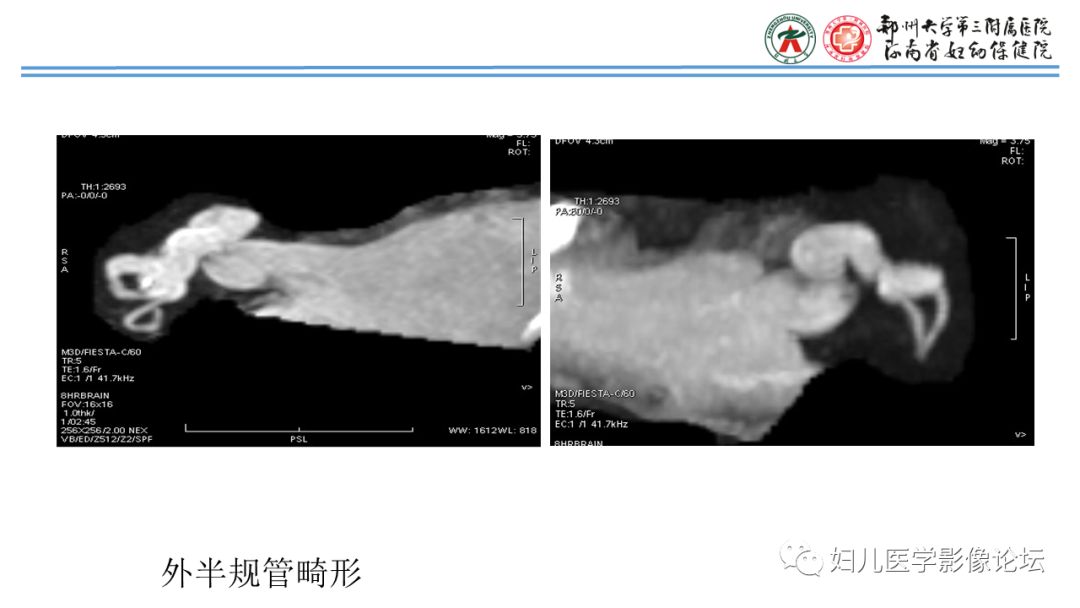影像PPT - 【PPT】感音神经性耳聋影像诊断-77