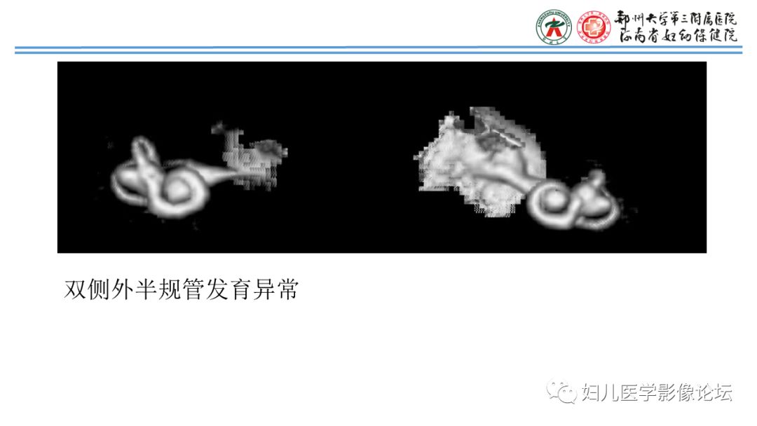 影像PPT - 【PPT】感音神经性耳聋影像诊断-79