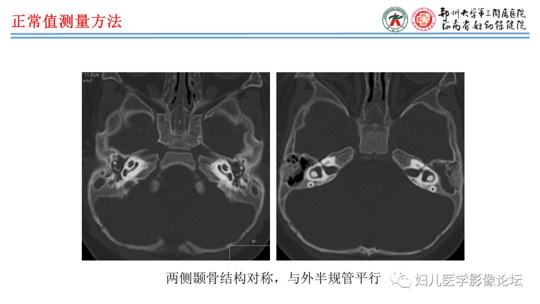 影像PPT - 【PPT】感音神经性耳聋影像诊断-80