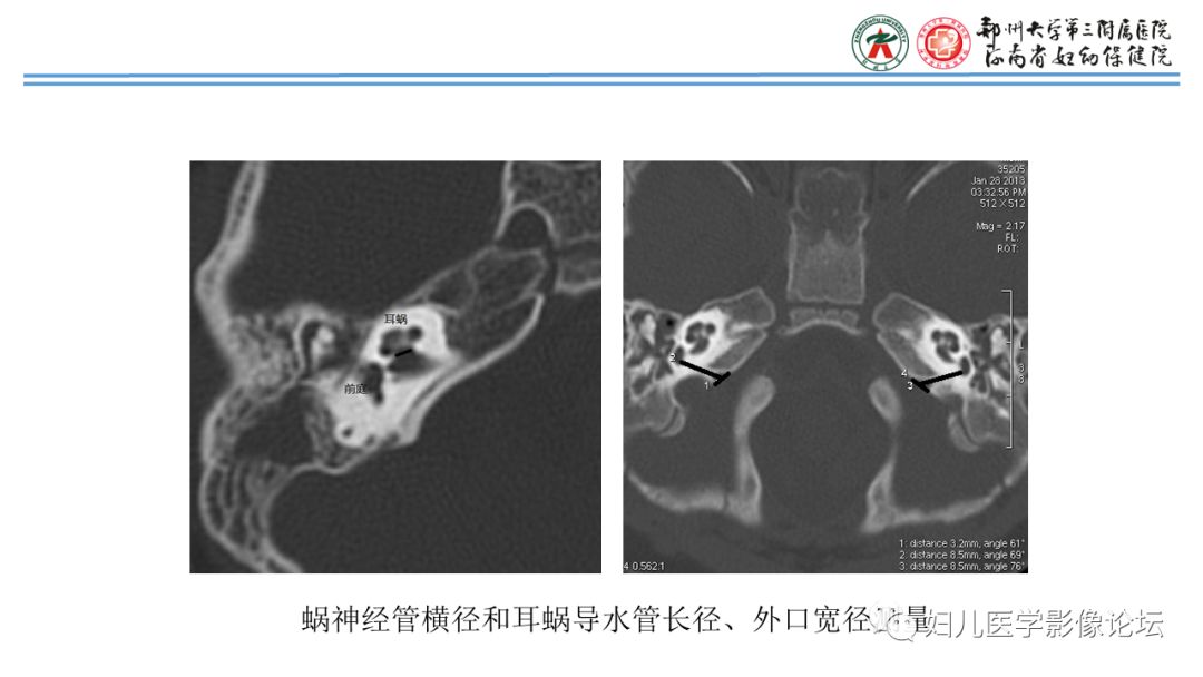 影像PPT - 【PPT】感音神经性耳聋影像诊断-82