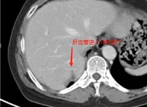 影像PPT - 【病例】胸腔内占位—异位肝1例CT影像-27 影像PPT - 【病例】胸腔内占位—异位肝1例CT影像-27