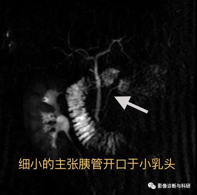 影像PPT - 胰腺炎反复发作的元凶——胰腺分裂-5