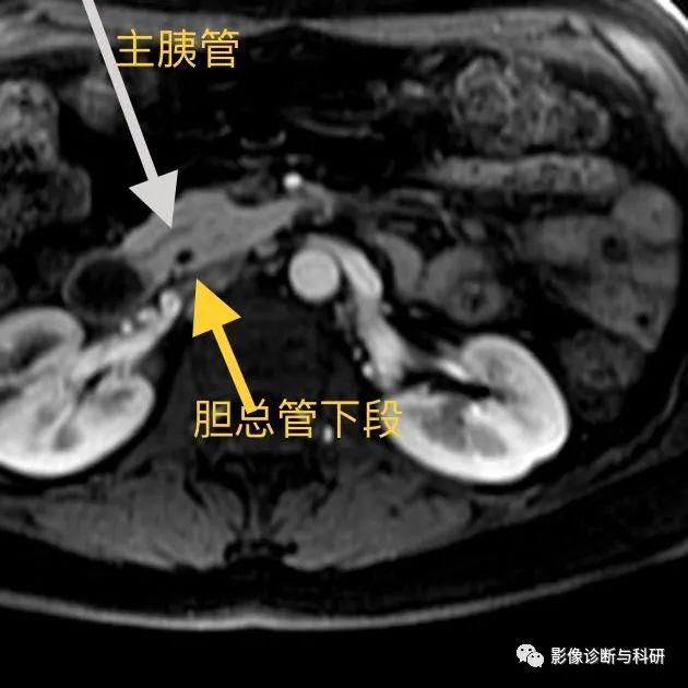 影像PPT - 胰腺炎反复发作的元凶——胰腺分裂-6