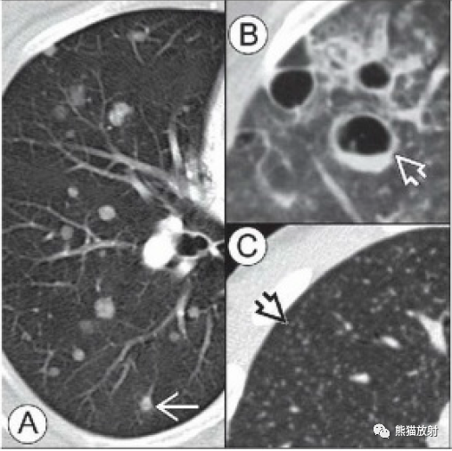 影像PPT - 肺HRCT征象要点速查速记-6 影像PPT - 肺HRCT征象要点速查速记-6