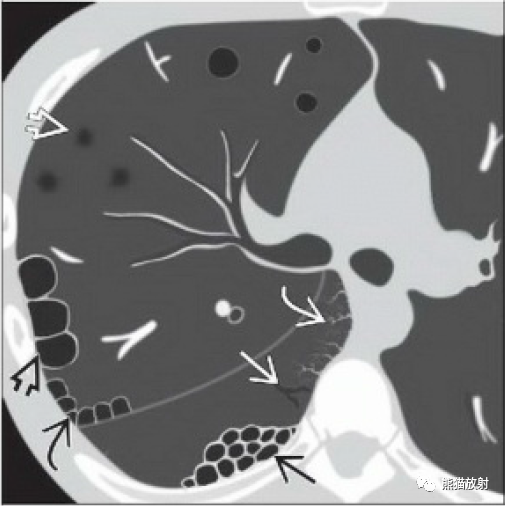 影像PPT - 肺HRCT征象要点速查速记-13 影像PPT - 肺HRCT征象要点速查速记-13