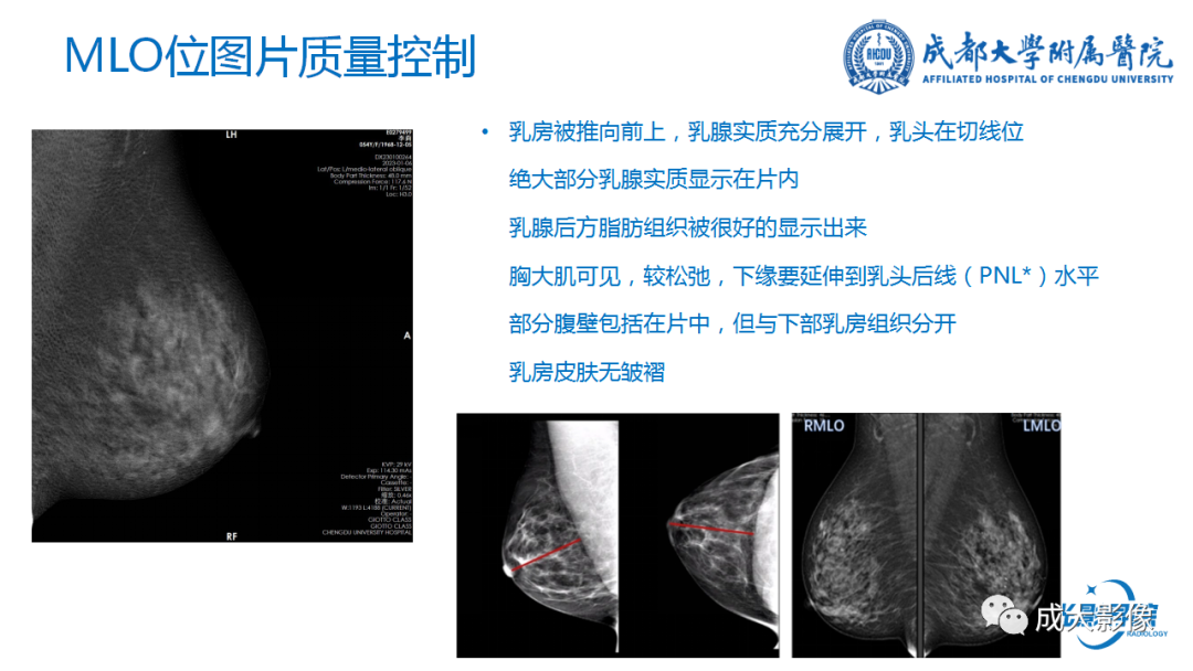 影像PPT - 【PPT】乳腺DBT初认识-10