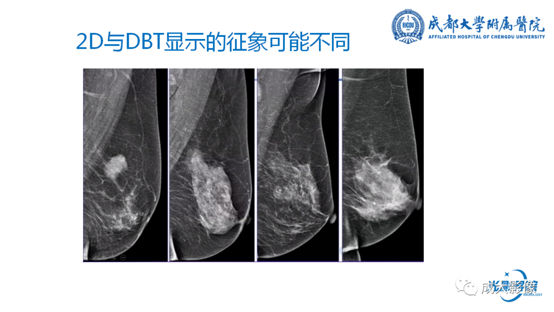 影像PPT - 【PPT】乳腺DBT初认识-12