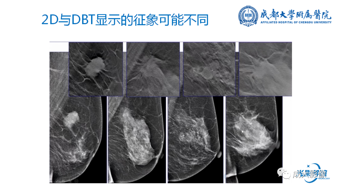 影像PPT - 【PPT】乳腺DBT初认识-13