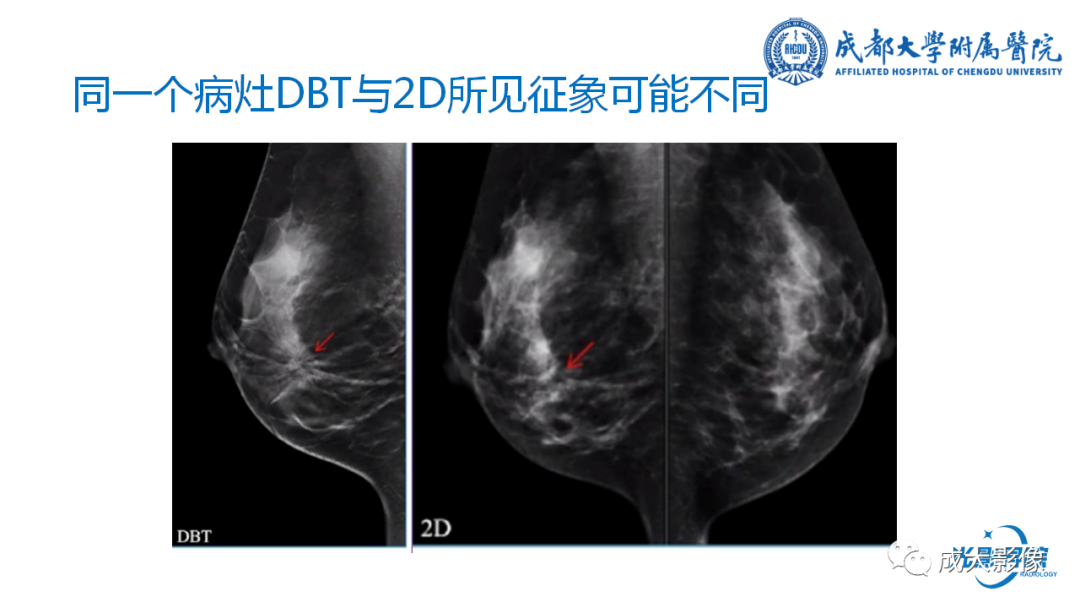 影像PPT - 【PPT】乳腺DBT初认识-18