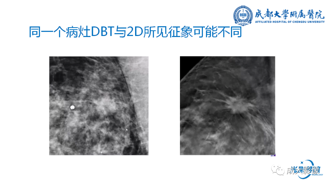 影像PPT - 【PPT】乳腺DBT初认识-19