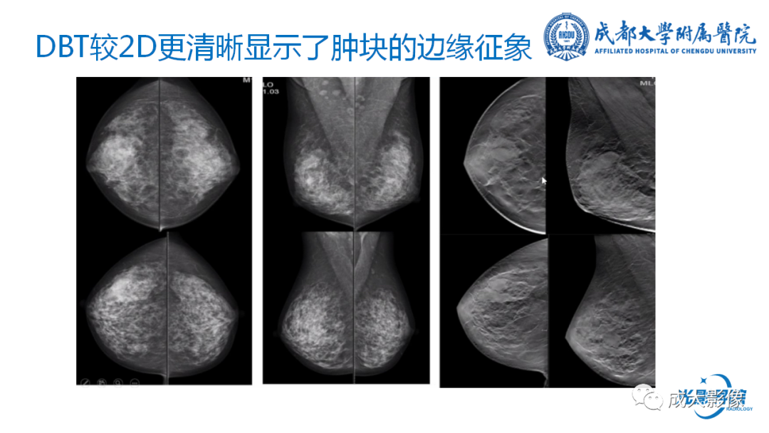 影像PPT - 【PPT】乳腺DBT初认识-20