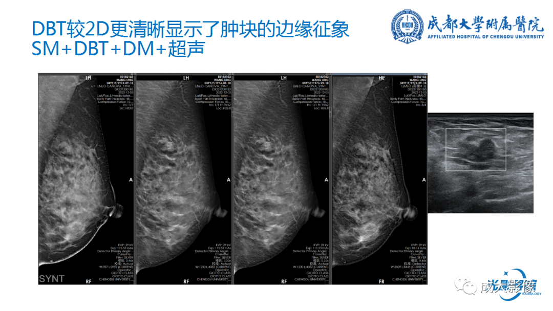 影像PPT - 【PPT】乳腺DBT初认识-21