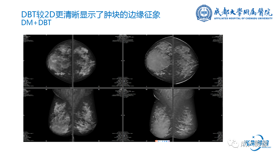 影像PPT - 【PPT】乳腺DBT初认识-22