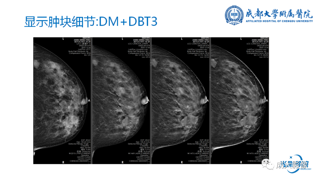 影像PPT - 【PPT】乳腺DBT初认识-23