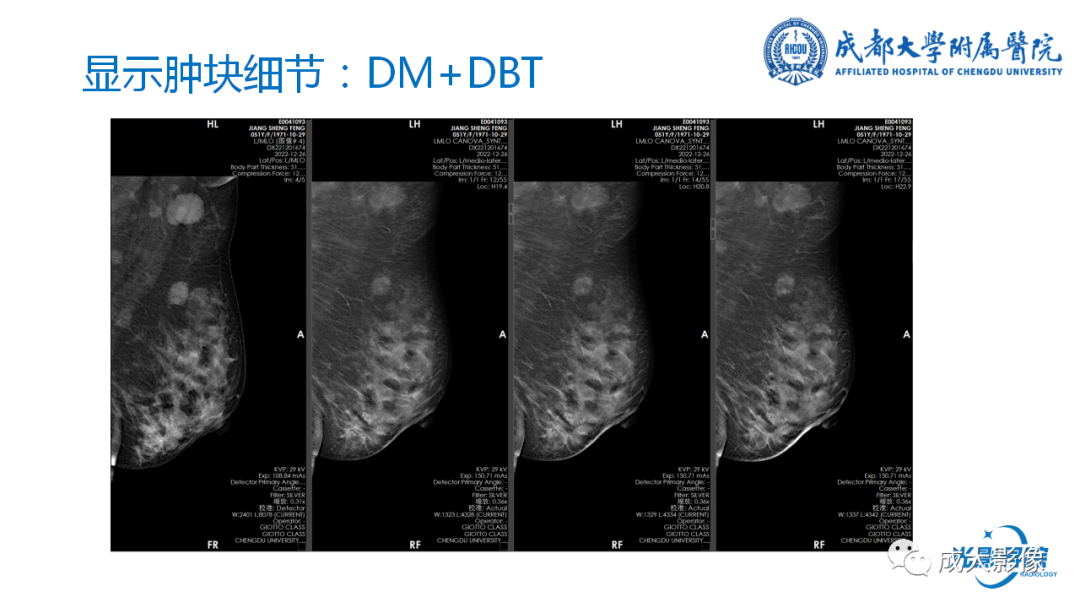 影像PPT - 【PPT】乳腺DBT初认识-24
