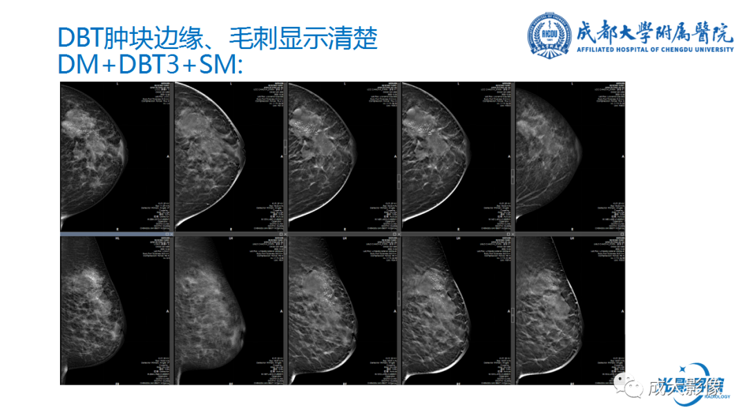 影像PPT - 【PPT】乳腺DBT初认识-25