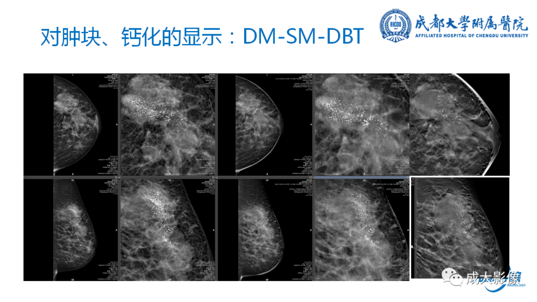 影像PPT - 【PPT】乳腺DBT初认识-28