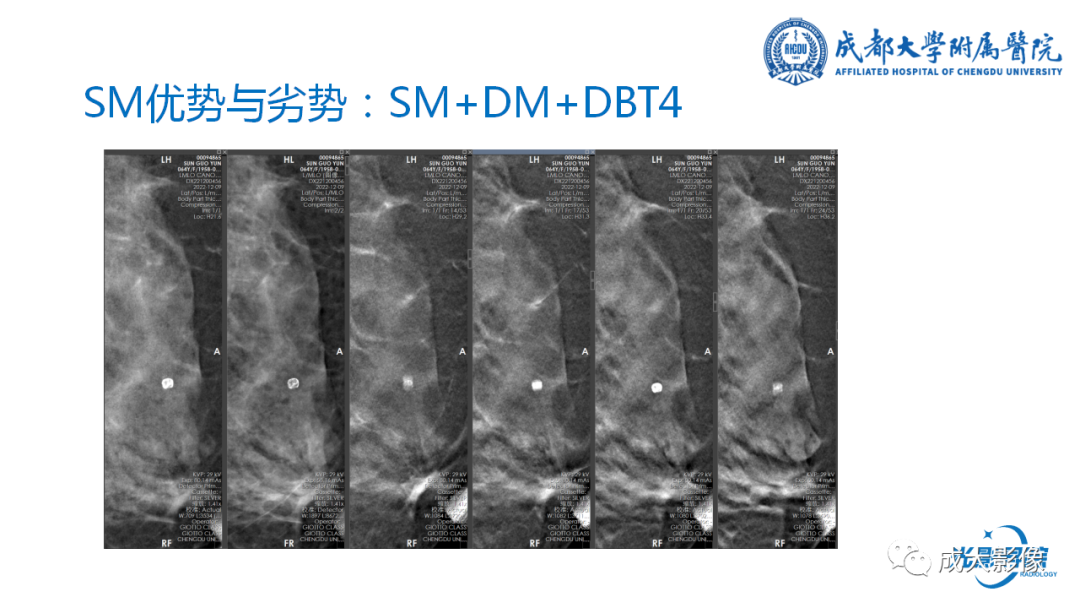 影像PPT - 【PPT】乳腺DBT初认识-29