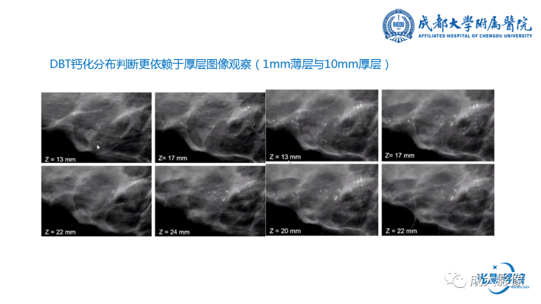 影像PPT - 【PPT】乳腺DBT初认识-30