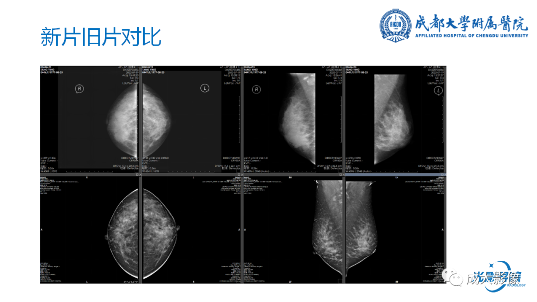 影像PPT - 【PPT】乳腺DBT初认识-31