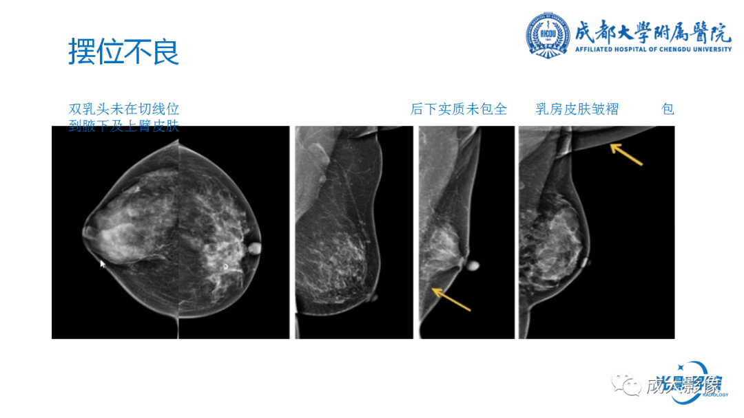 影像PPT - 【PPT】乳腺DBT初认识-37