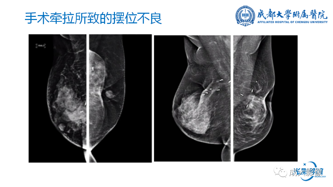 影像PPT - 【PPT】乳腺DBT初认识-38