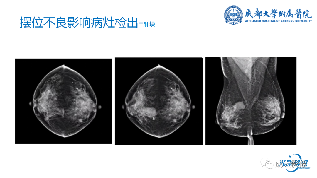 影像PPT - 【PPT】乳腺DBT初认识-39