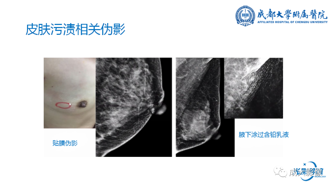 影像PPT - 【PPT】乳腺DBT初认识-40