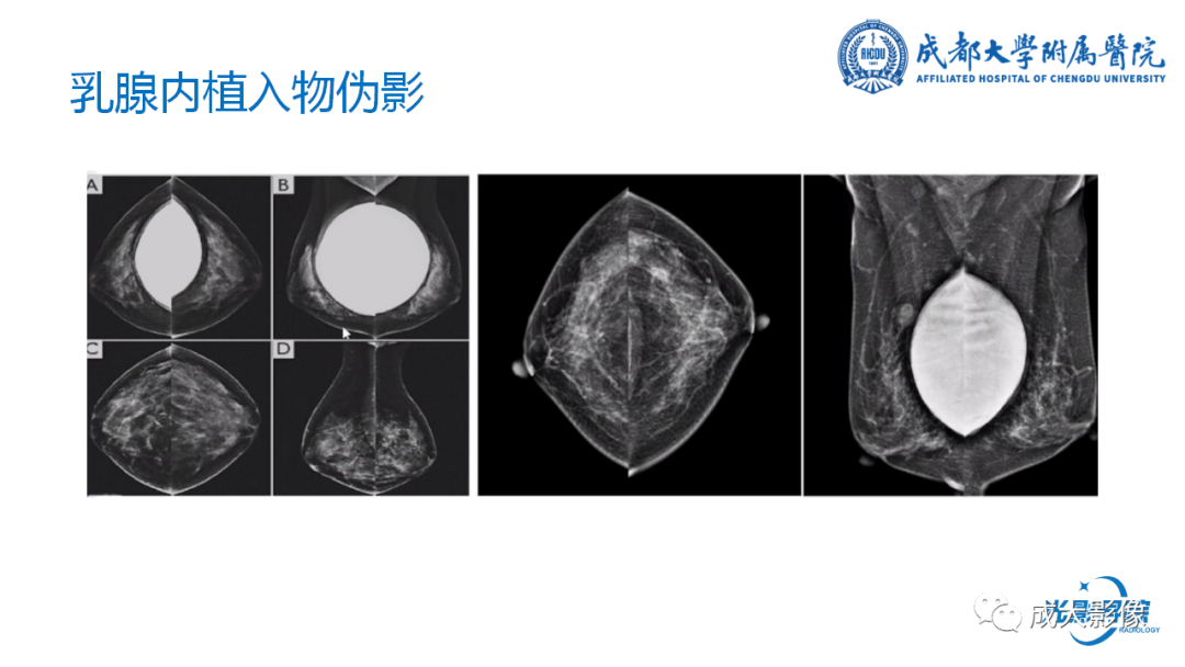 影像PPT - 【PPT】乳腺DBT初认识-41
