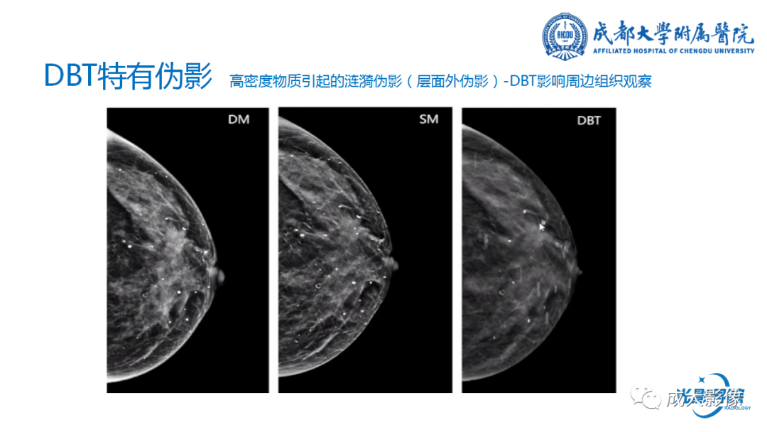 影像PPT - 【PPT】乳腺DBT初认识-42